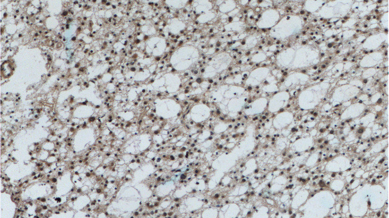 Immunohistochemistry of paraffin-embedded human gliomas tissue slide using Catalog No:114226(PrP Antibody) at dilution of 1:200 (under 10x lens)