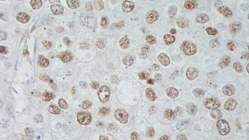 Immunohistochemistry of paraffin-embedded human breast cancer tissue slide using Catalog No:117338(TBP Antibody) at dilution of 1:400 (under 40x lens).