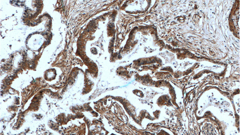 Immunohistochemistry of paraffin-embedded human pancreas cancer tissue slide using Catalog No:107762(ADAM17 Antibody) at dilution of 1:200 (under 10x lens).