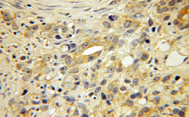 Immunohistochemical of paraffin-embedded human prostate cancer using Catalog No:110302(EDF1 antibody) at dilution of 1:50 (under 10x lens)