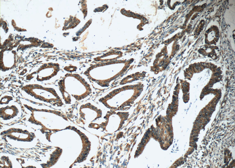 Immunohistochemistry of paraffin-embedded human colon cancer tissue slide using Catalog No:114524(RAF1 Antibody) at dilution of 1:50 (under 10x lens)