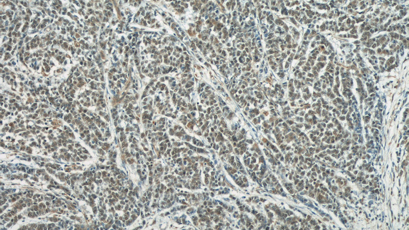 Immunohistochemical of paraffin-embedded human colon cancer using Catalog No:108005(AREG antibody) at dilution of 1:50 (under 10x lens)