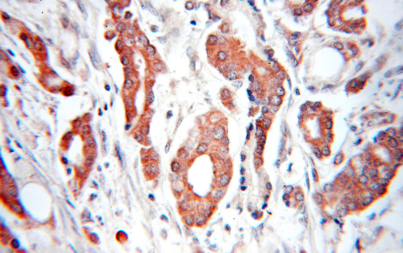 Immunohistochemical of paraffin-embedded human prostate cancer using Catalog No:110560(FBXO9 antibody) at dilution of 1:50 (under 10x lens)