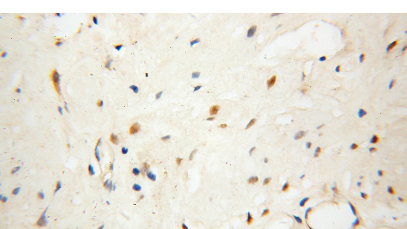 Immunohistochemical of paraffin-embedded human prostate cancer using Catalog No:113179(NHP2 antibody) at dilution of 1:100 (under 40x lens)