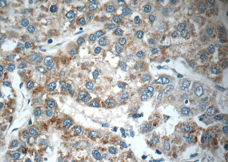 Immunohistochemistry of paraffin-embedded human liver cancer tissue slide using Catalog No:110114(DUSP10 Antibody) at dilution of 1:50 (under 40x lens)