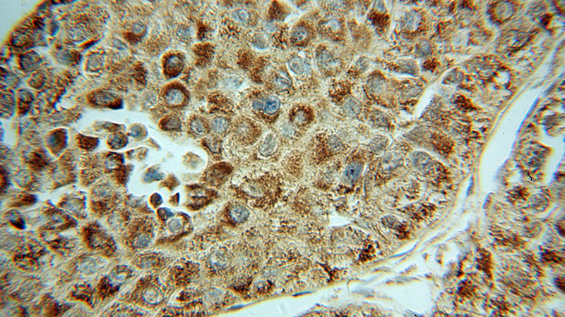 Immunohistochemical of paraffin-embedded human liver cancer using Catalog No:111340(HIBADH antibody) at dilution of 1:50 (under 40x lens)
