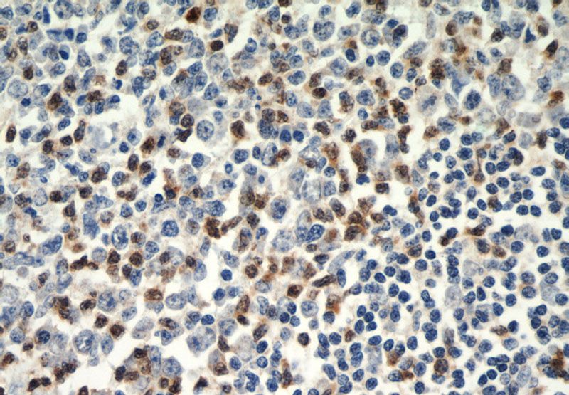 Immunohistochemical of paraffin-embedded human tonsillitis using Catalog No:116904(ZAP70 antibody) at dilution of 1:50 (under 40x lens)