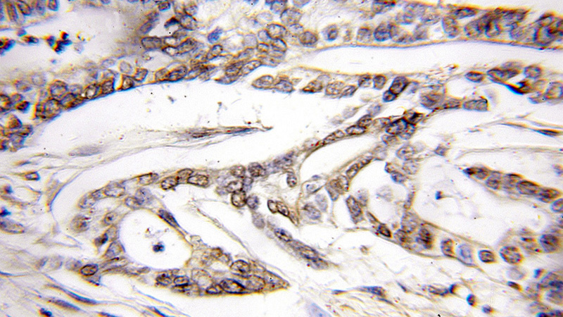 Immunohistochemical of paraffin-embedded human pancreas cancer using Catalog No:113948(PLCD4 antibody) at dilution of 1:50 (under 10x lens)