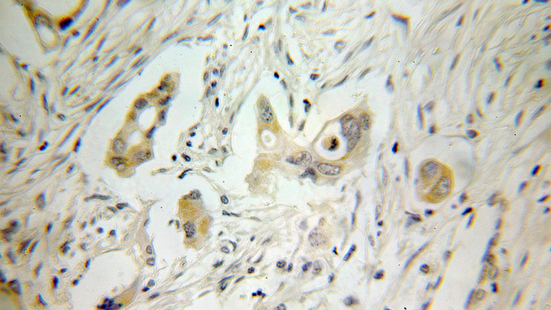 Immunohistochemical of paraffin-embedded human pancreas cancer using Catalog No:111180(GSTA2 antibody) at dilution of 1:100 (under 10x lens)