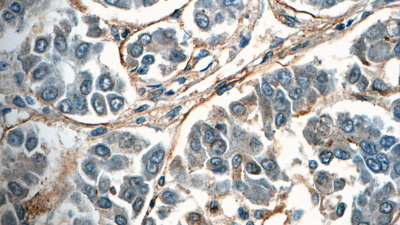 Immunohistochemistry of paraffin-embedded human liver cancer tissue slide using Catalog No:116109(TMEM181 Antibody) at dilution of 1:50 (under 40x lens)