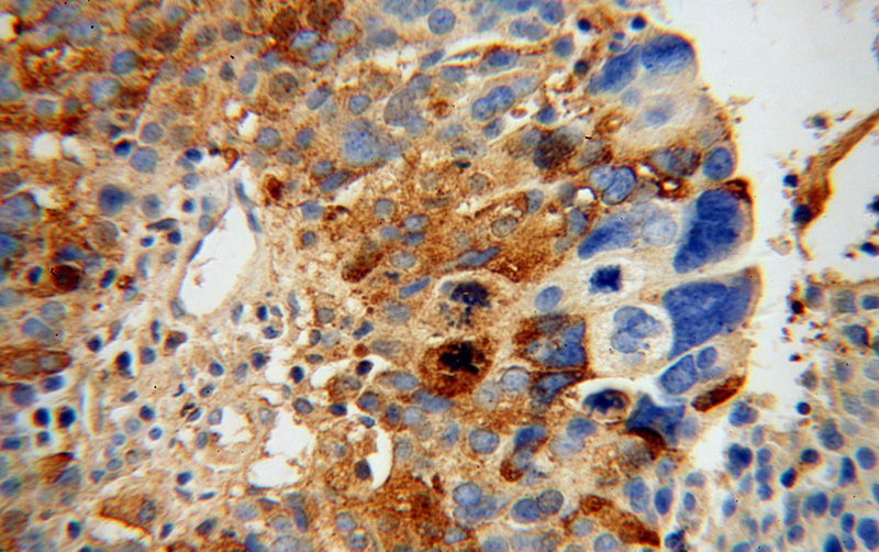 Immunohistochemical of paraffin-embedded human ovary tumor using Catalog No:113240(NLN antibody) at dilution of 1:50 (under 40x lens)