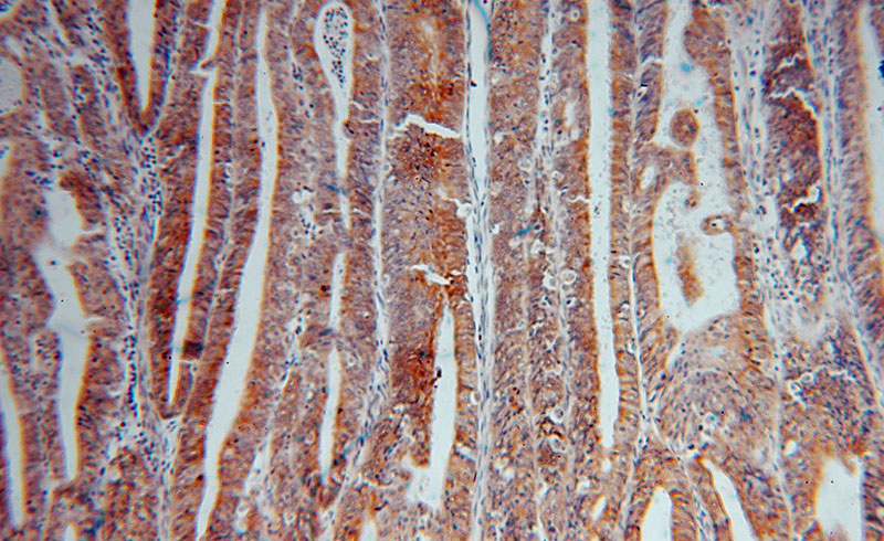 Immunohistochemical of paraffin-embedded human endometrial cancer using Catalog No:115795(STX18 antibody) at dilution of 1:100 (under 10x lens)