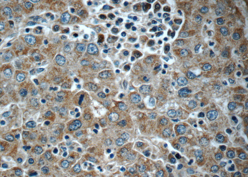 Immunohistochemistry of paraffin-embedded human liver cancer tissue slide using Catalog No:112037(C6orf221 Antibody) at dilution of 1:50 (under 40x lens)