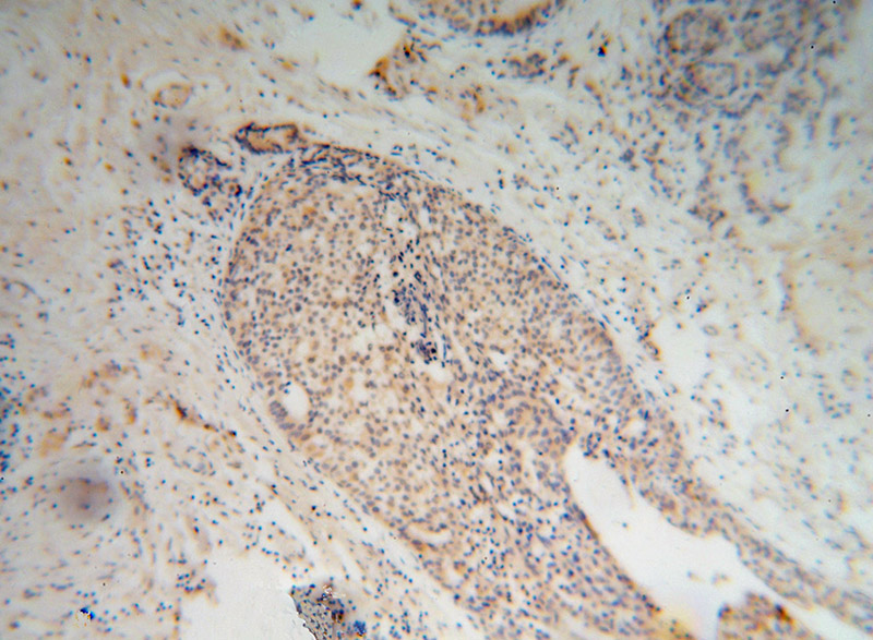 Immunohistochemical of paraffin-embedded human breast cancer using Catalog No:110112(DUS3L antibody) at dilution of 1:100 (under 10x lens)