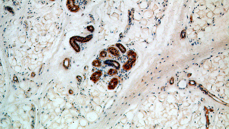 Immunohistochemical of paraffin-embedded human skin using Catalog No:107810(ABHD12B antibody) at dilution of 1:50 (under 10x lens)