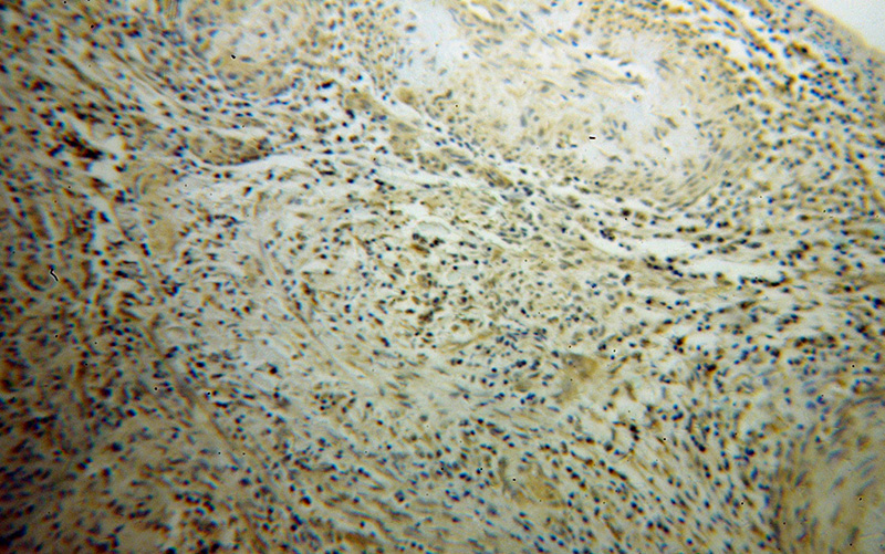 Immunohistochemical of paraffin-embedded human cervical cancer using Catalog No:114040(POLR2C antibody) at dilution of 1:100 (under 10x lens)