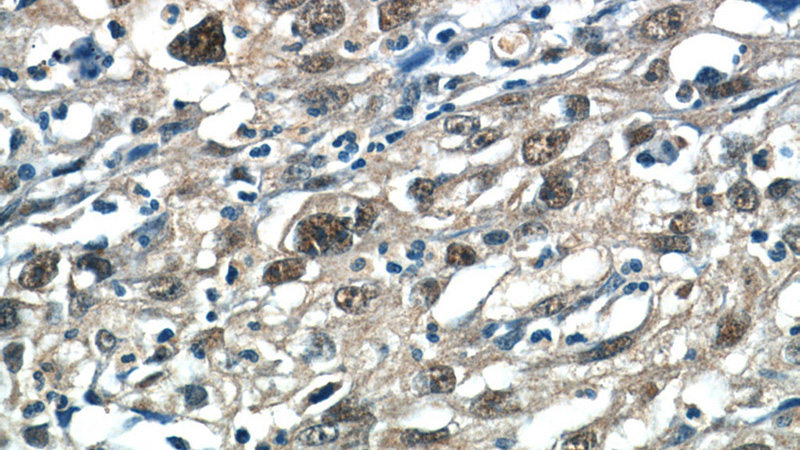 Immunohistochemistry of paraffin-embedded human cervical cancer tissue slide using Catalog No:114822(RPP25 Antibody) at dilution of 1:50 (under 40x lens)