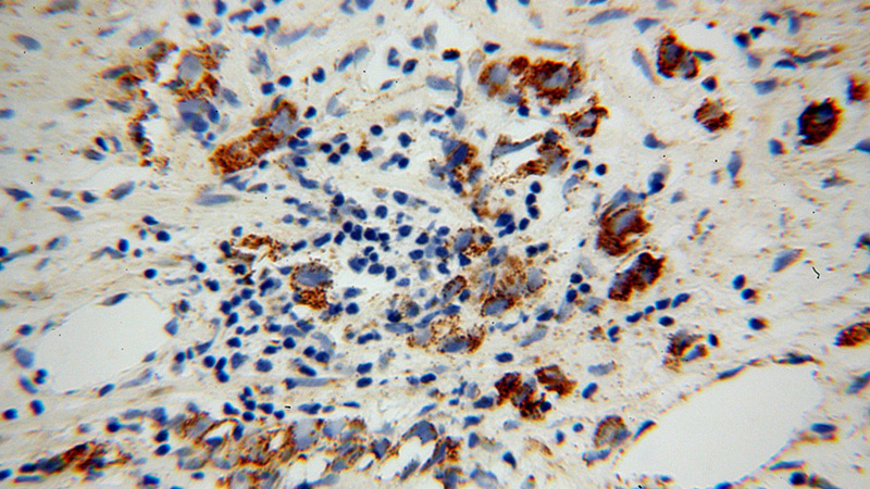 Immunohistochemical of paraffin-embedded human gliomas using Catalog No:108851(CPA6 antibody) at dilution of 1:100 (under 40x lens)