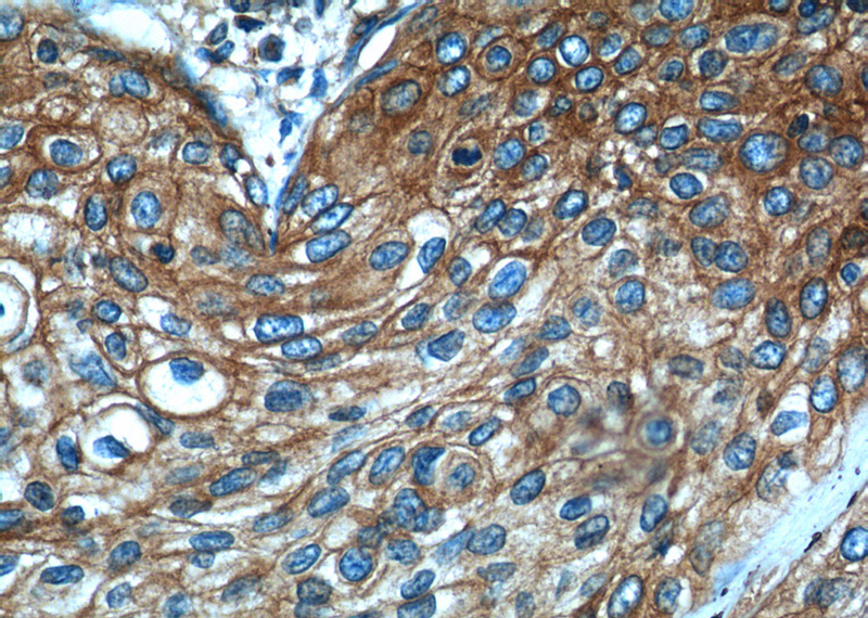 Immunohistochemistry of paraffin-embedded human oesophagus cancer tissue slide using Catalog No:117131(B2M Antibody) at dilution of 1:50 (under 40x lens)