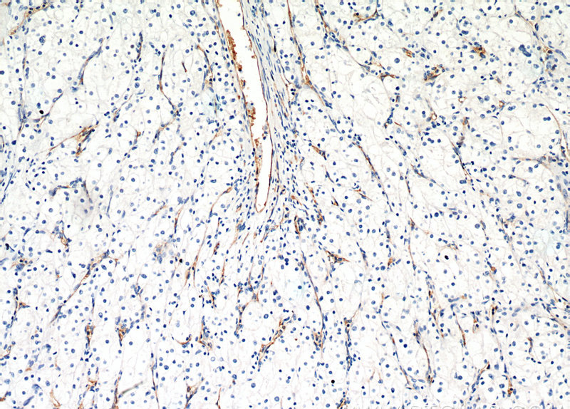 Immunohistochemistry of paraffin-embedded human renal cell carcinoma tissue slide using Catalog No:107918(AGER Antibody) at dilution of 1:200 (under 10x lens).