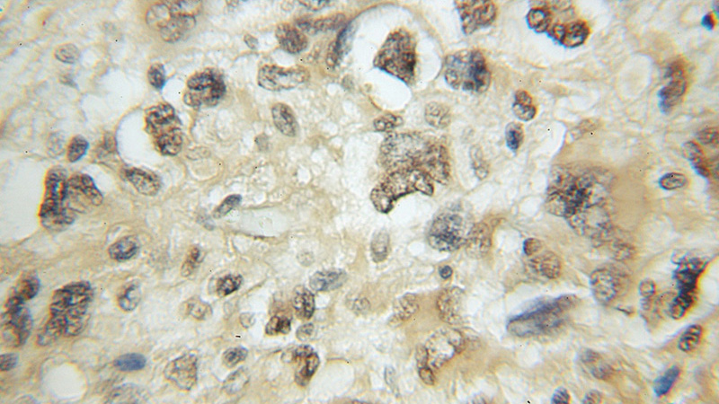 Immunohistochemical of paraffin-embedded human gliomas using Catalog No:110500(EXoc7 antibody) at dilution of 1:50 (under 10x lens)