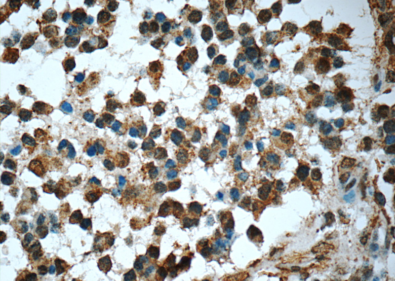 Immunohistochemistry of paraffin-embedded human gliomas tissue slide using Catalog No:107282(FUS/TLS Antibody) at dilution of 1:50 (under 40x lens)