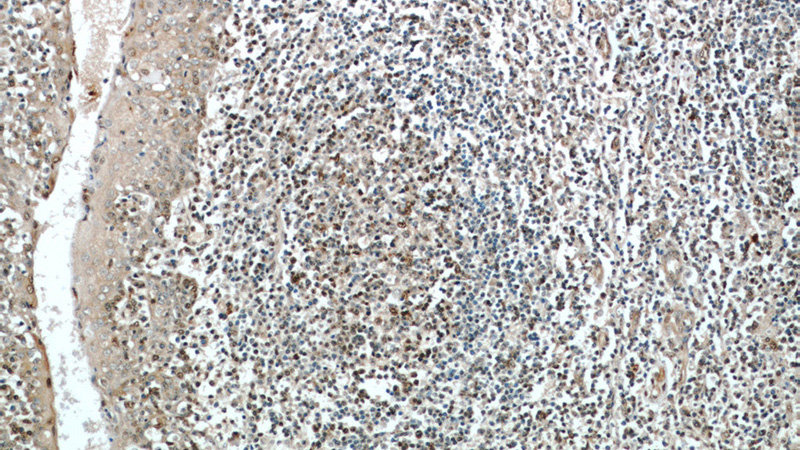 Immunohistochemical of paraffin-embedded human tonsillitis using Catalog No:115841(SUPT16H antibody) at dilution of 1:100 (under 10x lens)