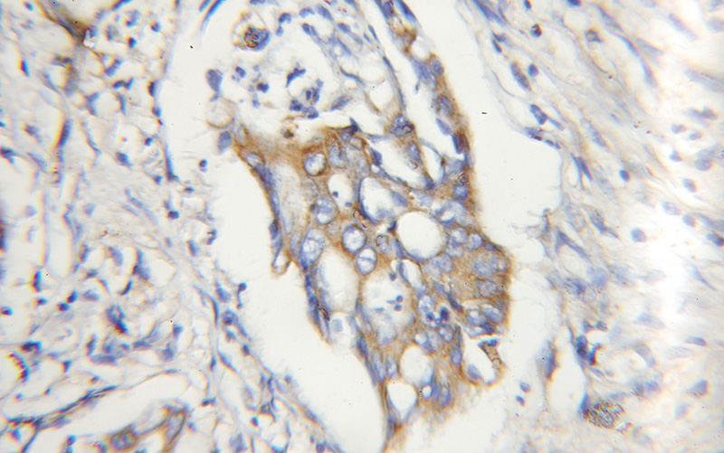 Immunohistochemical of paraffin-embedded human colon cancer using Catalog No:108835(CAPN2 antibody) at dilution of 1:50 (under 10x lens)