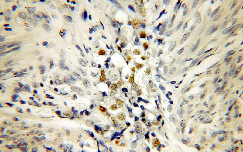 Immunohistochemical of paraffin-embedded human endometrial cancer using Catalog No:113553(P53 antibody) at dilution of 1:100 (under 40x lens)