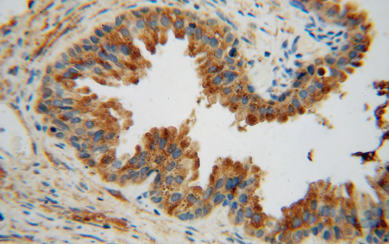 Immunohistochemical of paraffin-embedded human gliomas using Catalog No:116270(TMOD2 antibody) at dilution of 1:100 (under 40x lens)