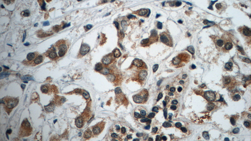 Immunohistochemistry of paraffin-embedded human breast cancer tissue slide using Catalog No:108655(C13orf37 Antibody) at dilution of 1:50 (under 40x lens)