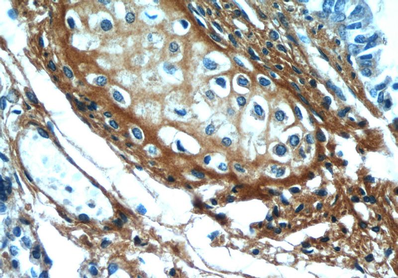 Immunohistochemical of paraffin-embedded human lung using Catalog No:113505(OGN antibody) at dilution of 1:50 (under 40x lens)