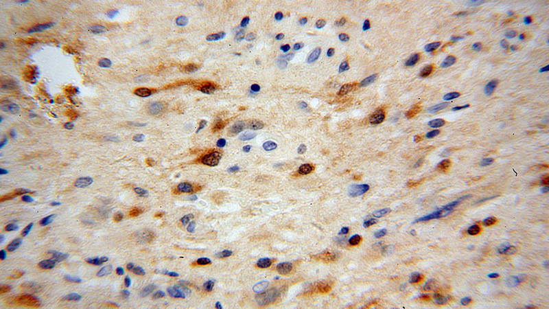 Immunohistochemical of paraffin-embedded human gliomas using Catalog No:107772(ADAP1 antibody) at dilution of 1:100 (under 40x lens)