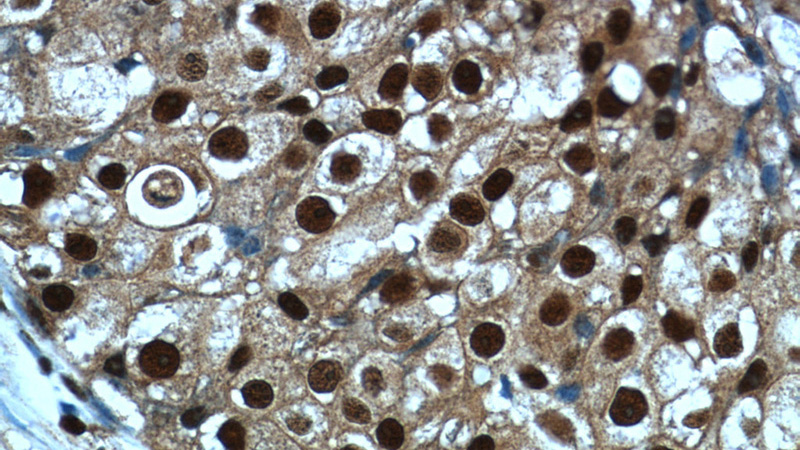 Immunohistochemistry of paraffin-embedded human breast cancer tissue slide using Catalog No:115662(SRA1 Antibody) at dilution of 1:50 (under 40x lens)