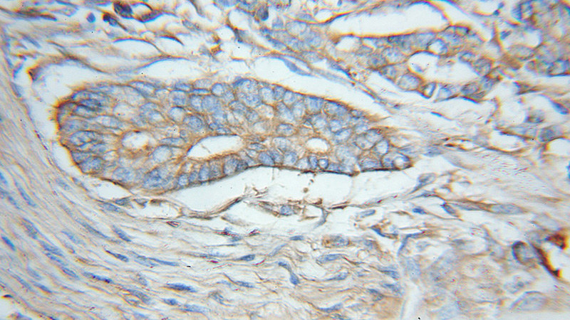 Immunohistochemical of paraffin-embedded human pancreas cancer using Catalog No:110200(EIF3M antibody) at dilution of 1:50 (under 10x lens)