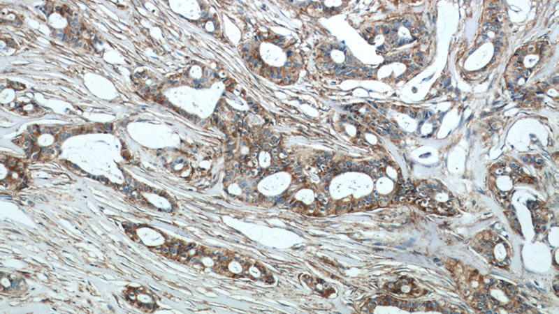 Immunohistochemical of paraffin-embedded human breast cancer using Catalog No:112563(SLC16A3 antibody) at dilution of 1:50 (under 10x lens)