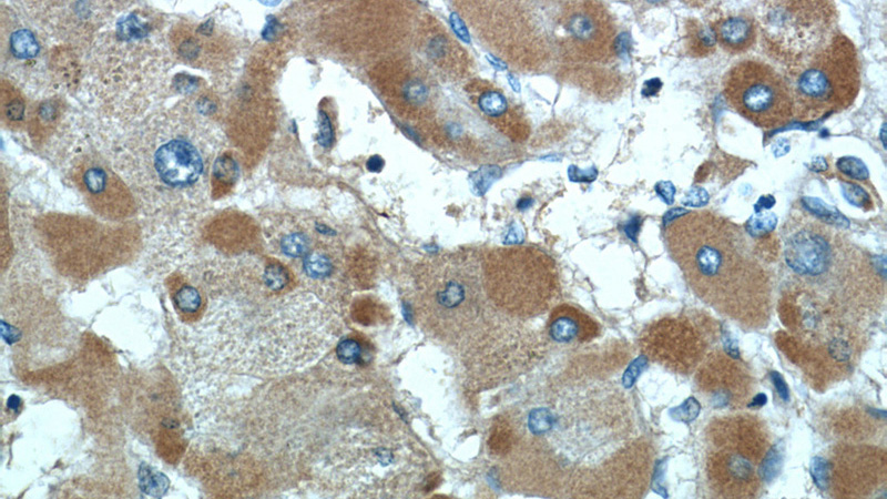 Immunohistochemistry of paraffin-embedded human hepatocirrhosis tissue slide using Catalog No:107877(A2M Antibody) at dilution of 1:50 (under 40x lens)