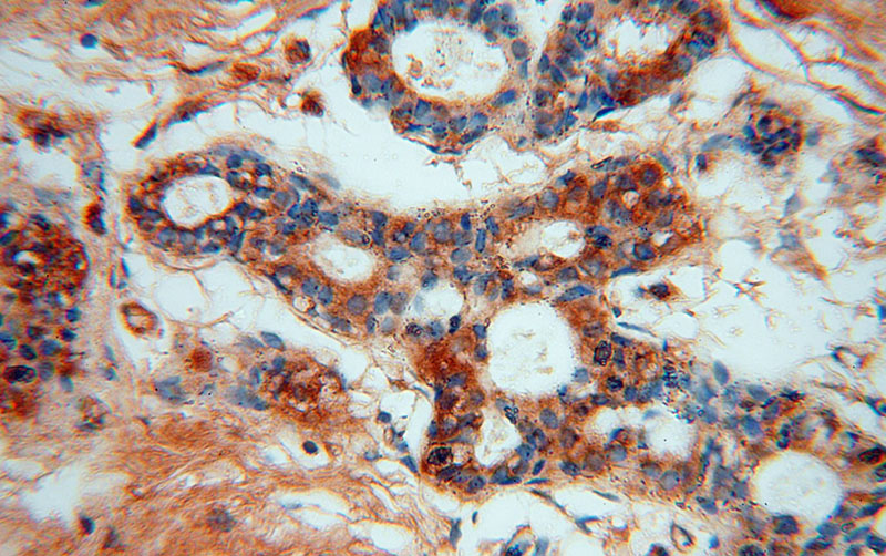 Immunohistochemical of paraffin-embedded human colon cancer using Catalog No:112812(MRPL13 antibody) at dilution of 1:50 (under 40x lens)