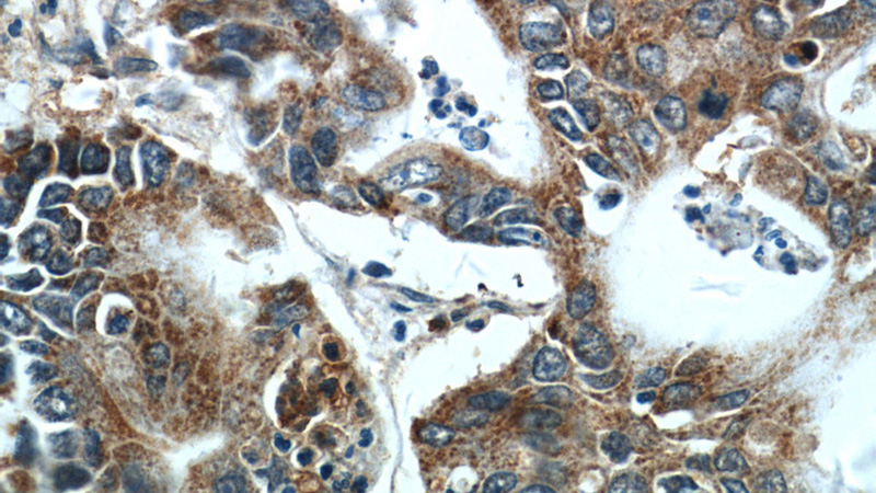 Immunohistochemistry of paraffin-embedded human pancreas cancer tissue slide using Catalog No:108294(ATG2B Antibody) at dilution of 1:50 (under 40x lens)