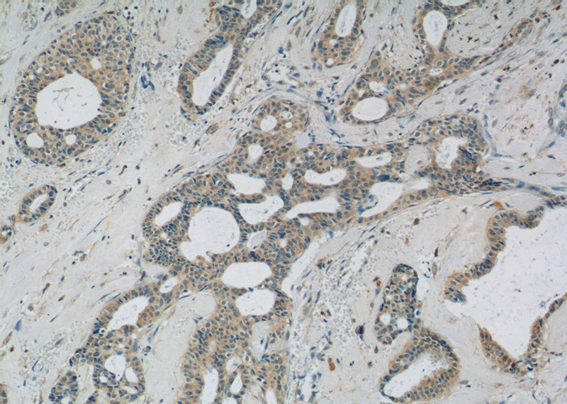 Immunohistochemistry of paraffin-embedded human breast cancer tissue slide using Catalog No:108646(C11orf83 Antibody) at dilution of 1:50 (under 10x lens)