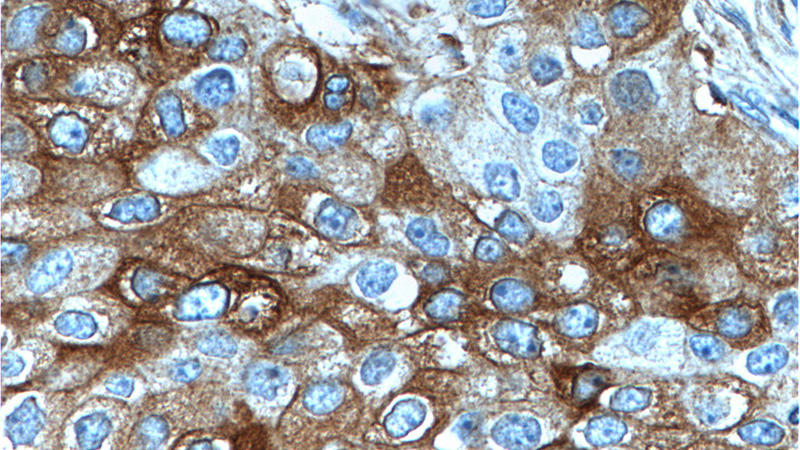 Immunohistochemistry of paraffin-embedded human breast cancer tissue slide using Catalog No:110747(FUT4 Antibody) at dilution of 1:200 (under 40x lens).