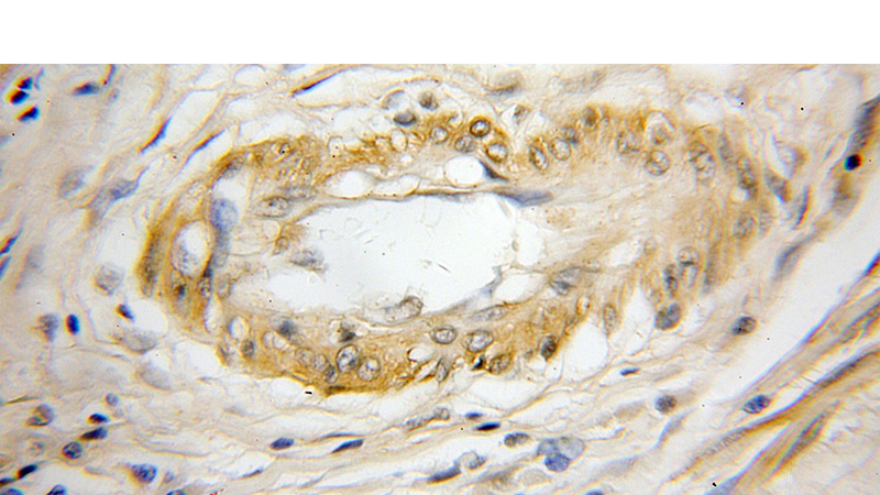 Immunohistochemical of paraffin-embedded human colon cancer using Catalog No:109716(CST7 antibody) at dilution of 1:50 (under 10x lens)