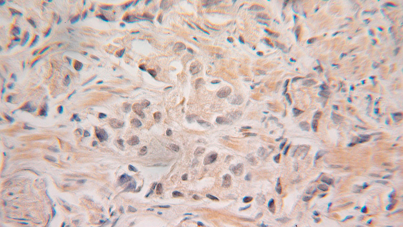 Immunohistochemical of paraffin-embedded human prostate cancer using Catalog No:111163(GRWD1 antibody) at dilution of 1:100 (under 25x lens)