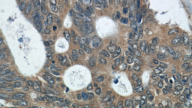 Immunohistochemistry of paraffin-embedded human colon cancer tissue slide using Catalog No:110619(FER Antibody) at dilution of 1:50 (under 40x lens)