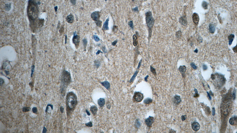 Immunohistochemistry of paraffin-embedded human brain tissue slide using Catalog No:114446(RAB3GAP2 Antibody) at dilution of 1:50 (under 40x lens)