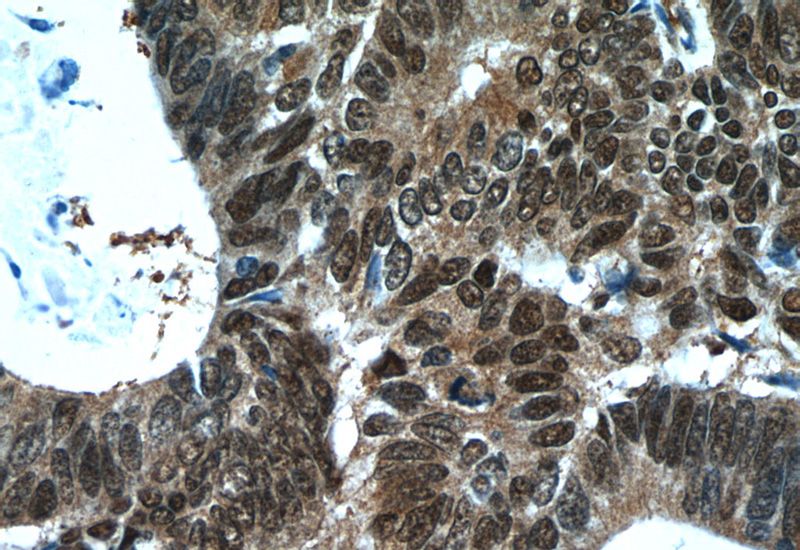 Immunohistochemistry of paraffin-embedded human colon cancer tissue slide using Catalog No:117270(ZWILCH Antibody) at dilution of 1:50 (under 40x lens)