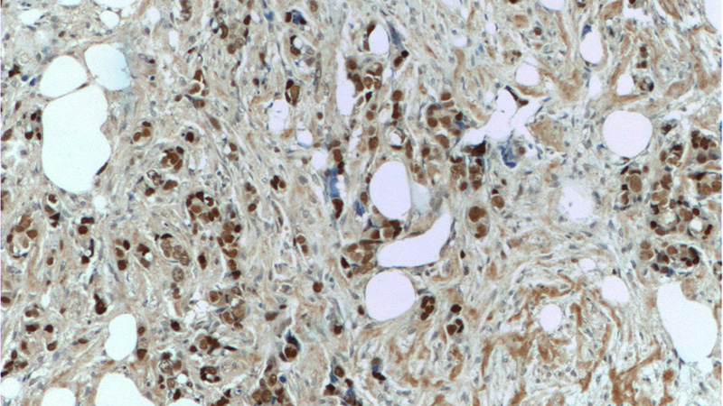 Immunohistochemistry of paraffin-embedded human breast cancer tissue slide using Catalog No:109096(CDC25A Antibody) at dilution of 1:50 (under 10x lens)