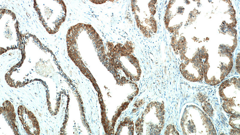 Immunohistochemical of paraffin-embedded human prostate hyperplasia using Catalog No:107812(ABHD14B antibody) at dilution of 1:50 (under 10x lens)