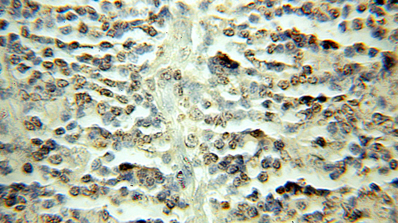 Immunohistochemical of paraffin-embedded human lymphoma using Catalog No:116006(TFDP1 antibody) at dilution of 1:50 (under 10x lens)