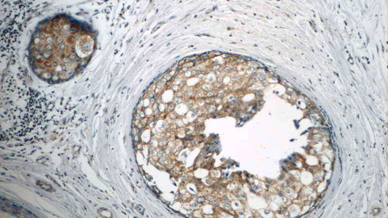 Immunohistochemistry of paraffin-embedded human breast cancer tissue slide using Catalog No:112495(MATK Antibody) at dilution of 1:50 (under 10x lens)